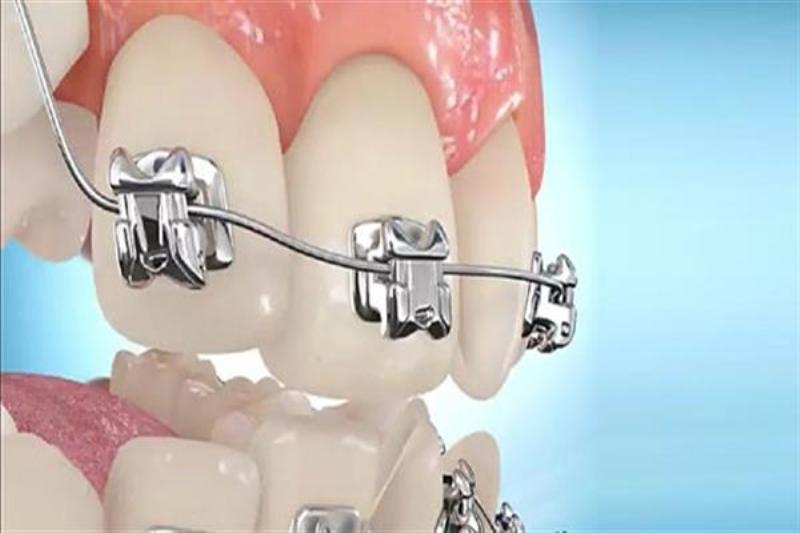 بهبود شکنندگی براکت های سرامیکی به کمک محققان ایرانی بهبود شکنندگی براکت های سرامیکی به کمک محققان ایرانی