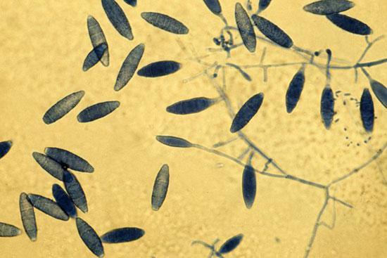 خارش ژوک یا خارش کشاله ران چیست؟