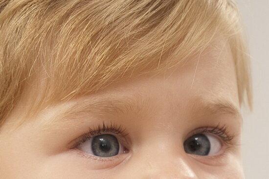 تنبلی چشم؛ رایج ترین دلیل نارسایی بینایی در بچه ها
