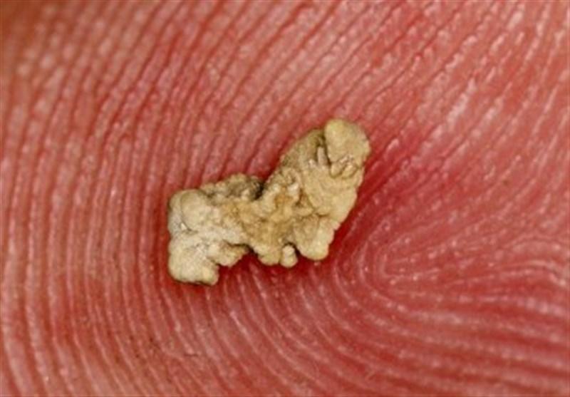 داروی جدید برای دفع راحت سنگ کلیه