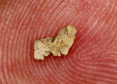 داروی جدید برای دفع راحت سنگ کلیه