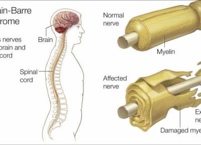 سندرم گیلن باره چیست؟ علایم و نشانه های آن کدامند؟ راه های تشخیص و درمان