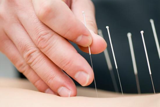 طب سوزنی و هرآنچه باید بدانید طب سوزنی و هرآنچه باید بدانید