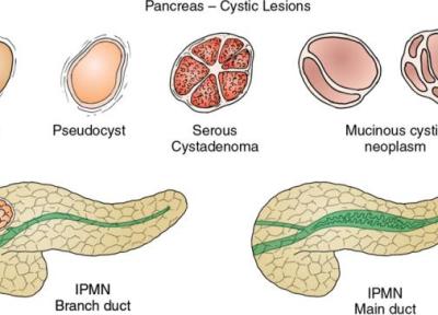 کیست پانکراس چه علائمی دارد و چطور درمان می گردد؟