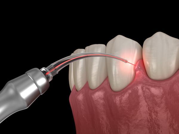 سلاح لیزری برای از بین بردن باکتری های دندان!